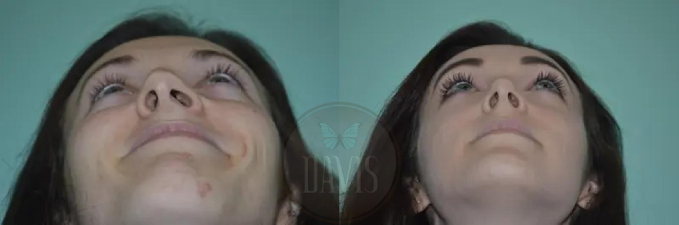 Before & After Female Rhinoplasty Case 1063 View 1 View in Tampa, FL