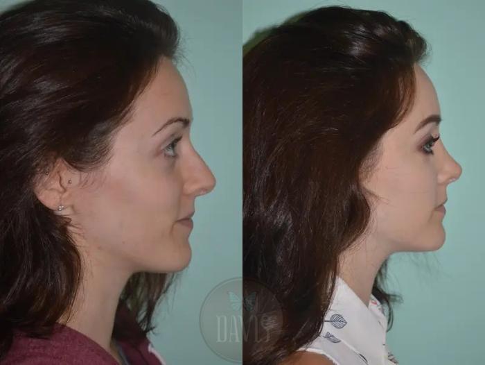 Before & After Female Rhinoplasty Case 1063 View 2 View in Tampa, FL