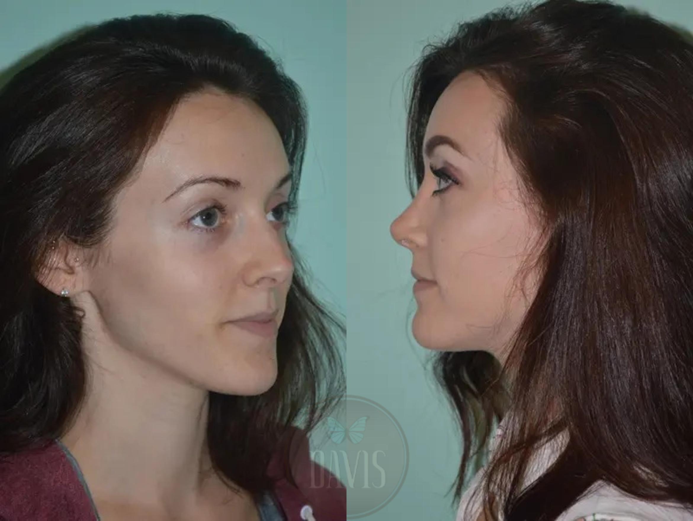 Before & After Female Rhinoplasty Case 1063 View 3 View in Tampa, FL