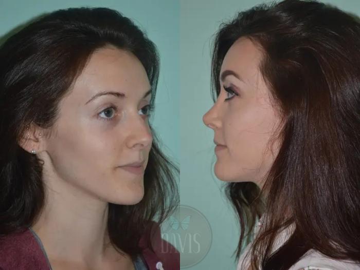 Before & After Female Rhinoplasty Case 1063 View 3 View in Tampa, FL