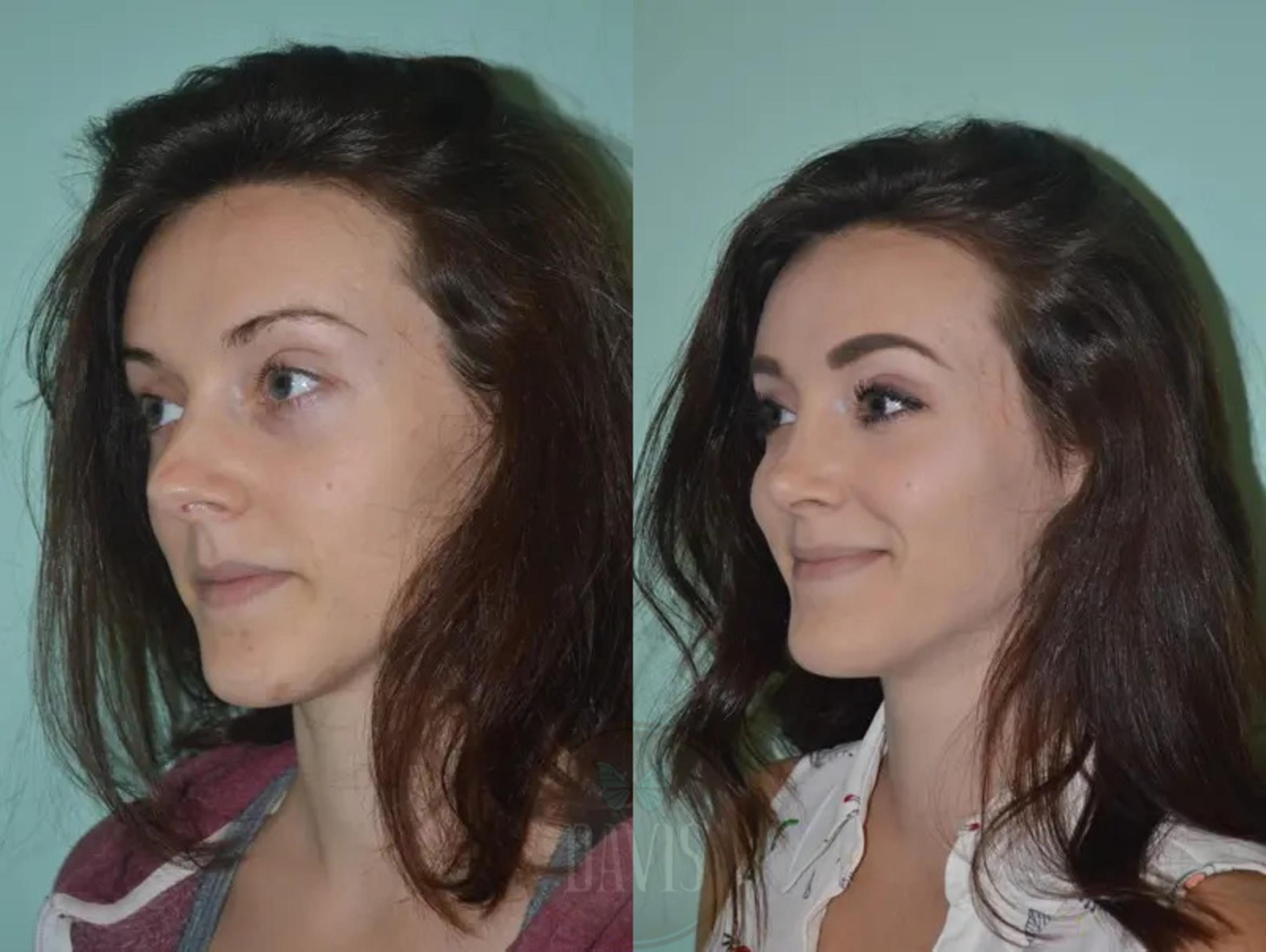Before & After Female Rhinoplasty Case 1063 View 4 View in Tampa, FL