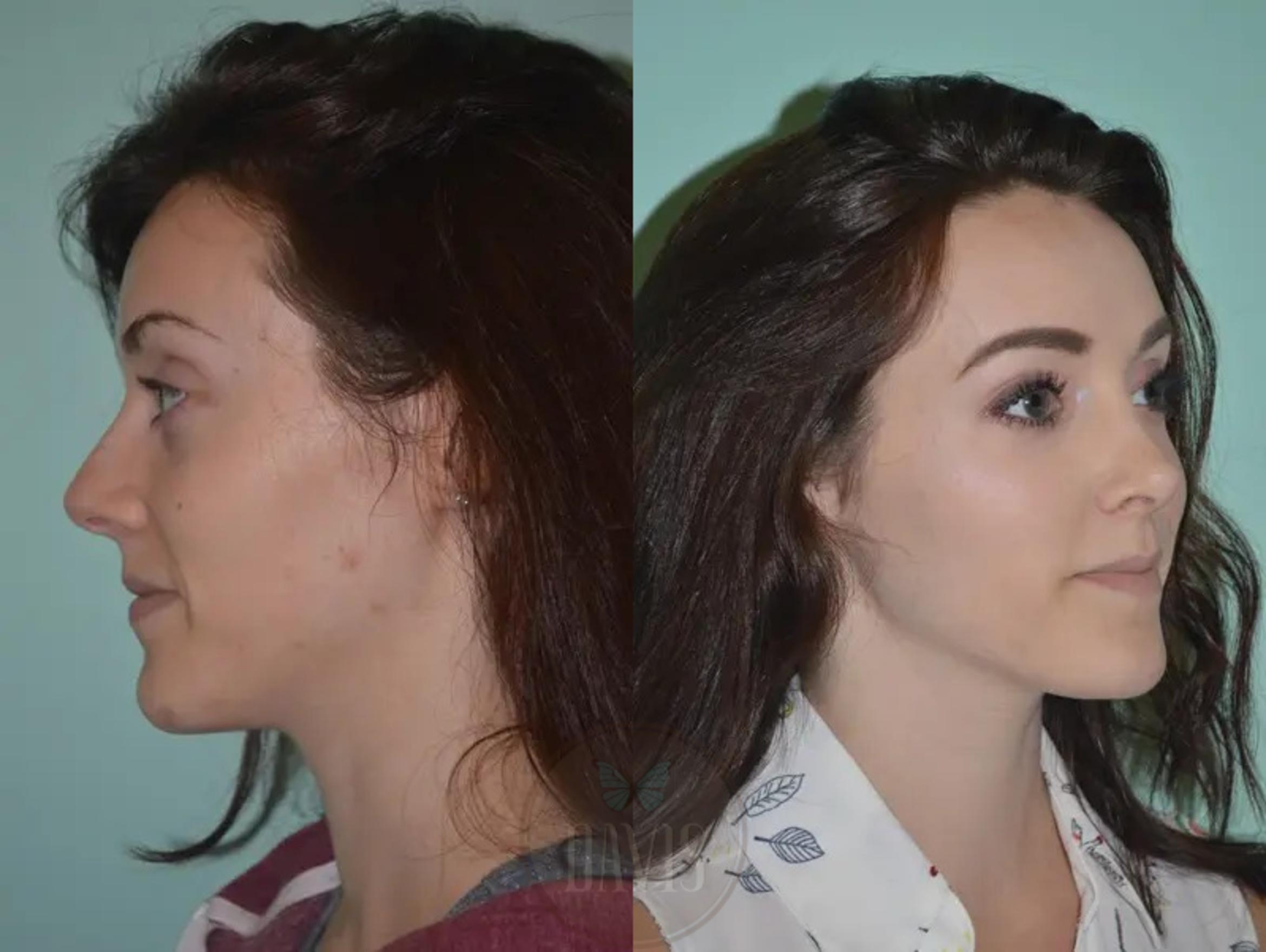 Before & After Female Rhinoplasty Case 1063 View 5 View in Tampa, FL