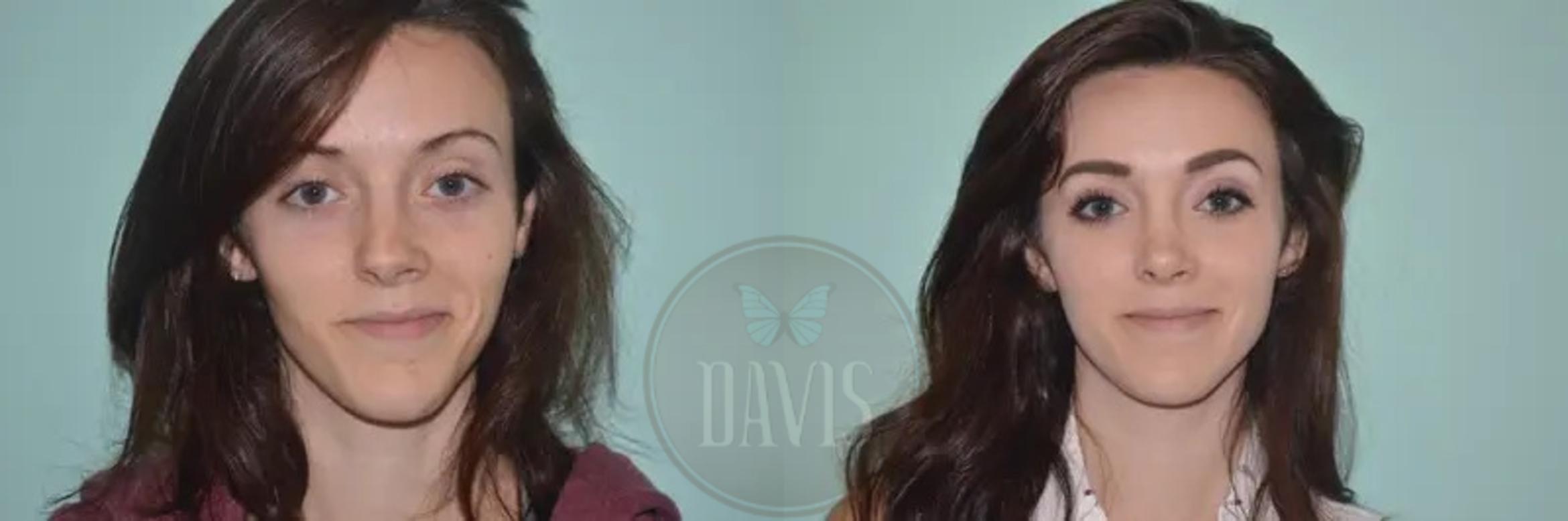 Before & After Female Rhinoplasty Case 1063 View 6 View in Tampa, FL