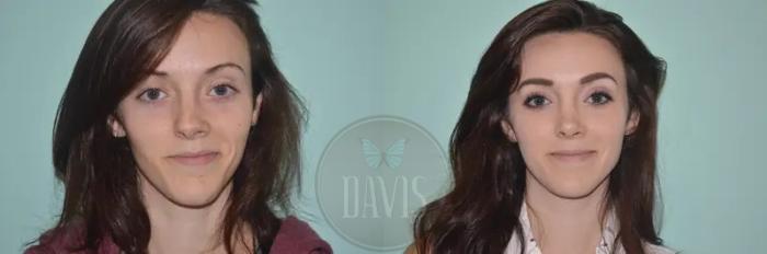 Before & After Female Rhinoplasty Case 1063 View 6 View in Tampa, FL