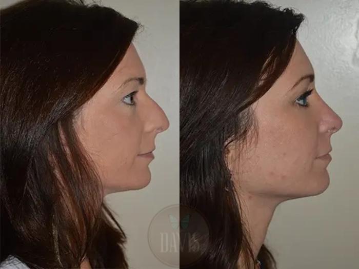 Before & After Female Rhinoplasty Case 1064 View 1 View in Tampa, FL