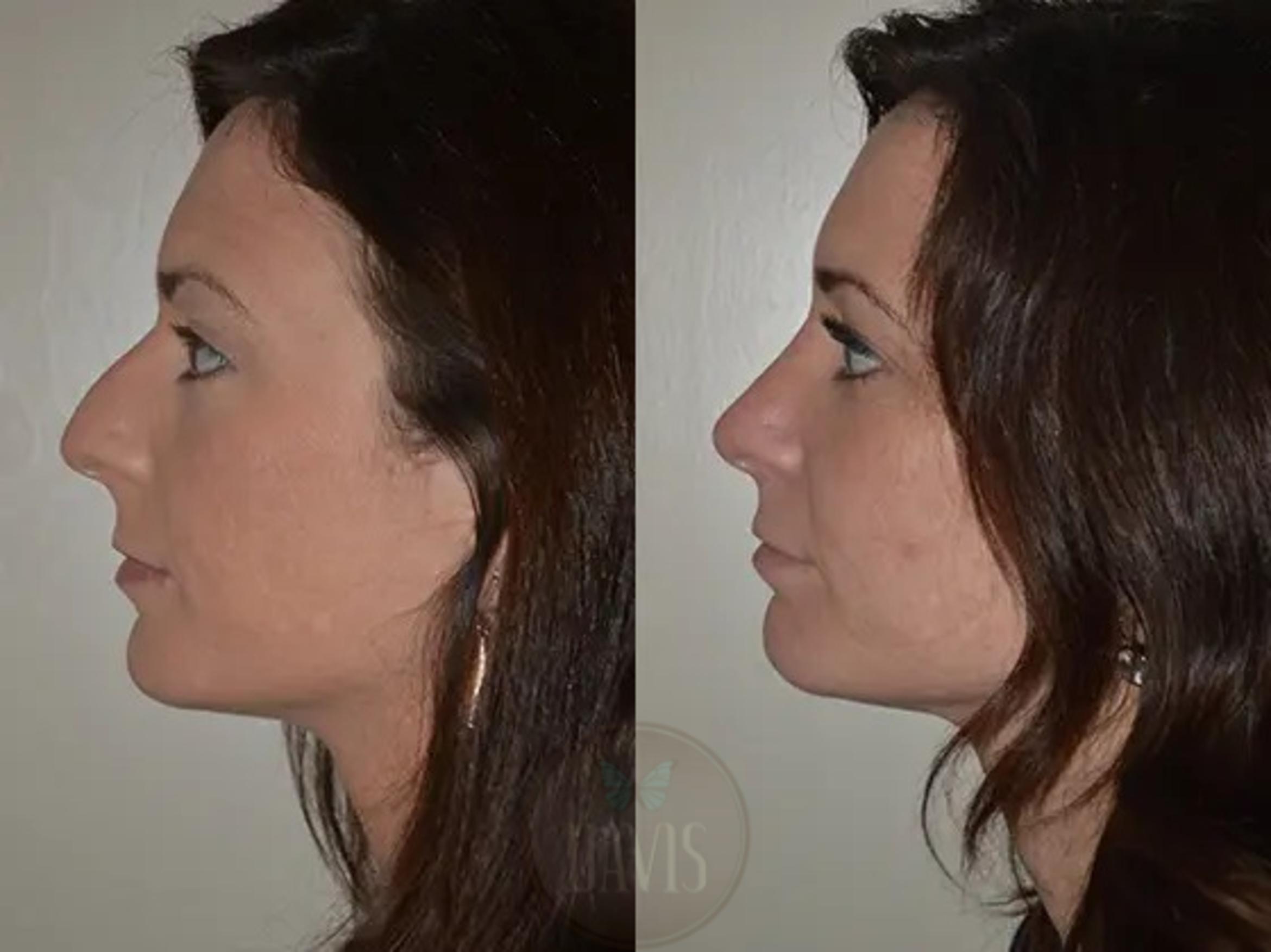 Before & After Female Rhinoplasty Case 1064 View 2 View in Tampa, FL