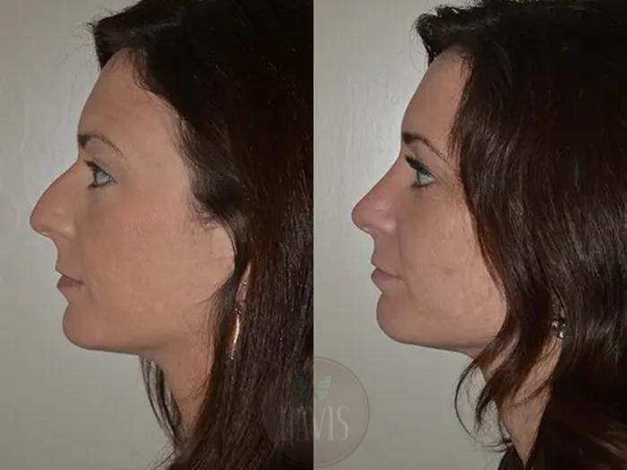 Before & After Female Rhinoplasty Case 1064 View 2 View in Tampa, FL