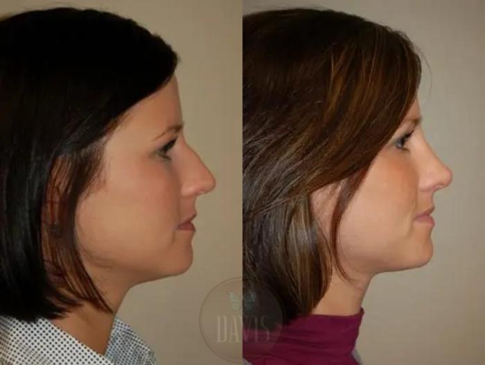 Before & After Female Rhinoplasty Case 1065 View 1 View in Tampa, FL