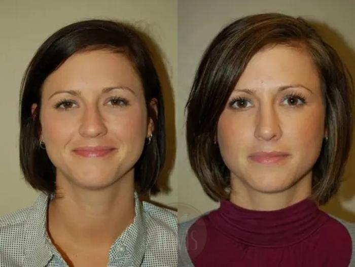 Before & After Female Rhinoplasty Case 1065 View 2 View in Tampa, FL