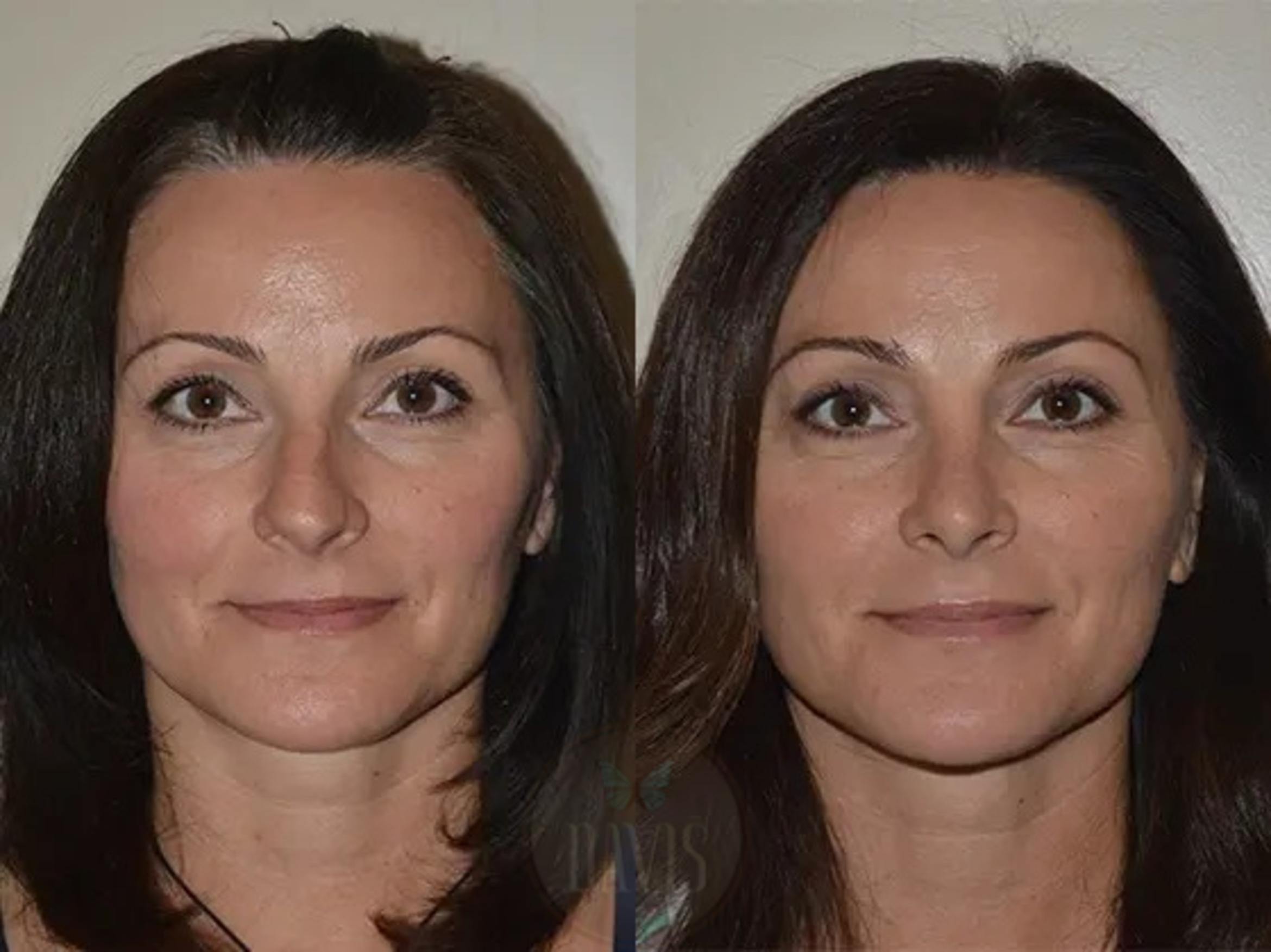 Before & After Female Rhinoplasty Case 1066 View 1 View in Tampa, FL