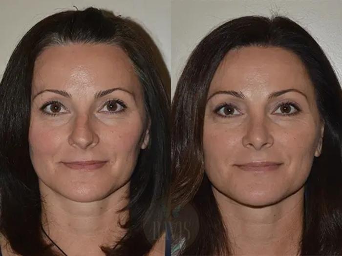 Before & After Female Rhinoplasty Case 1066 View 1 View in Tampa, FL