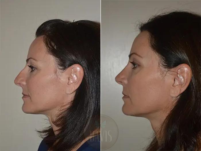 Before & After Female Rhinoplasty Case 1066 View 2 View in Tampa, FL