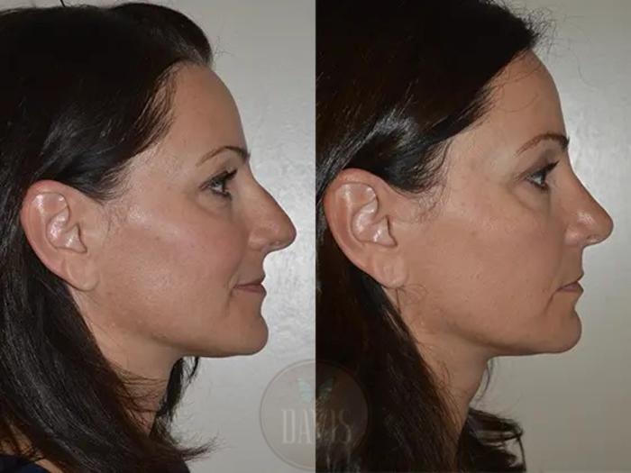 Before & After Female Rhinoplasty Case 1066 View 3 View in Tampa, FL
