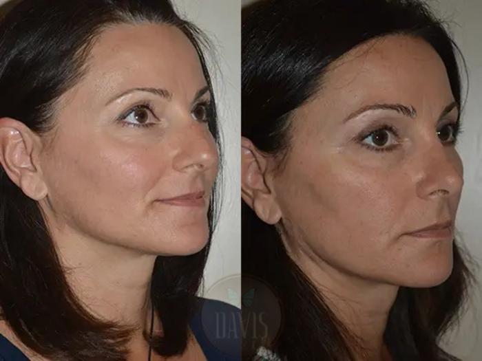Before & After Female Rhinoplasty Case 1066 View 4 View in Tampa, FL