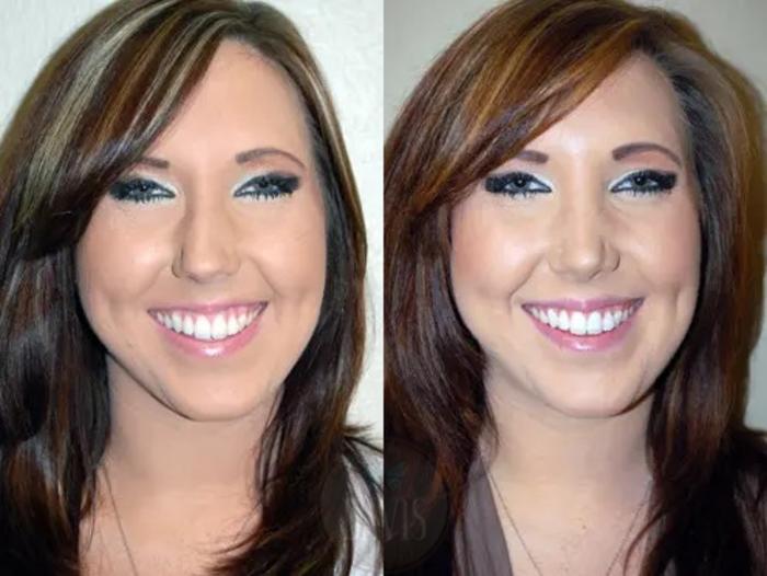 Before & After Female Rhinoplasty Case 1067 View 1 View in Tampa, FL