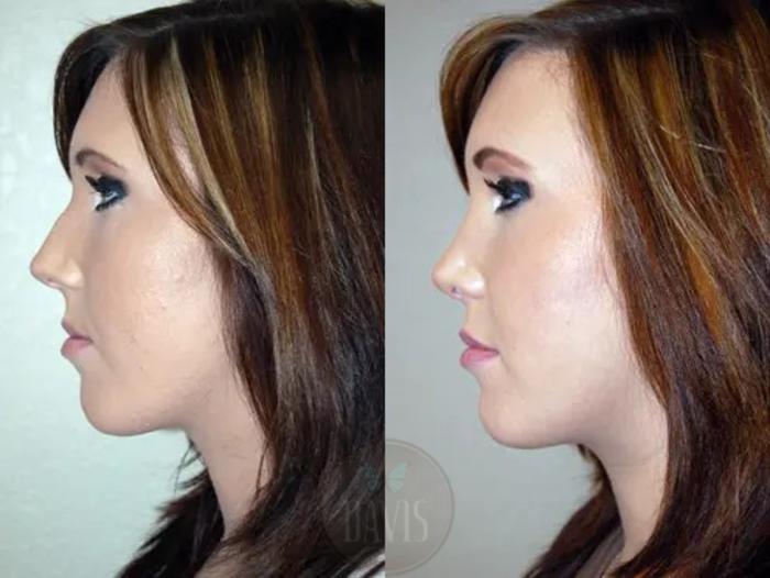 Before & After Female Rhinoplasty Case 1067 View 2 View in Tampa, FL