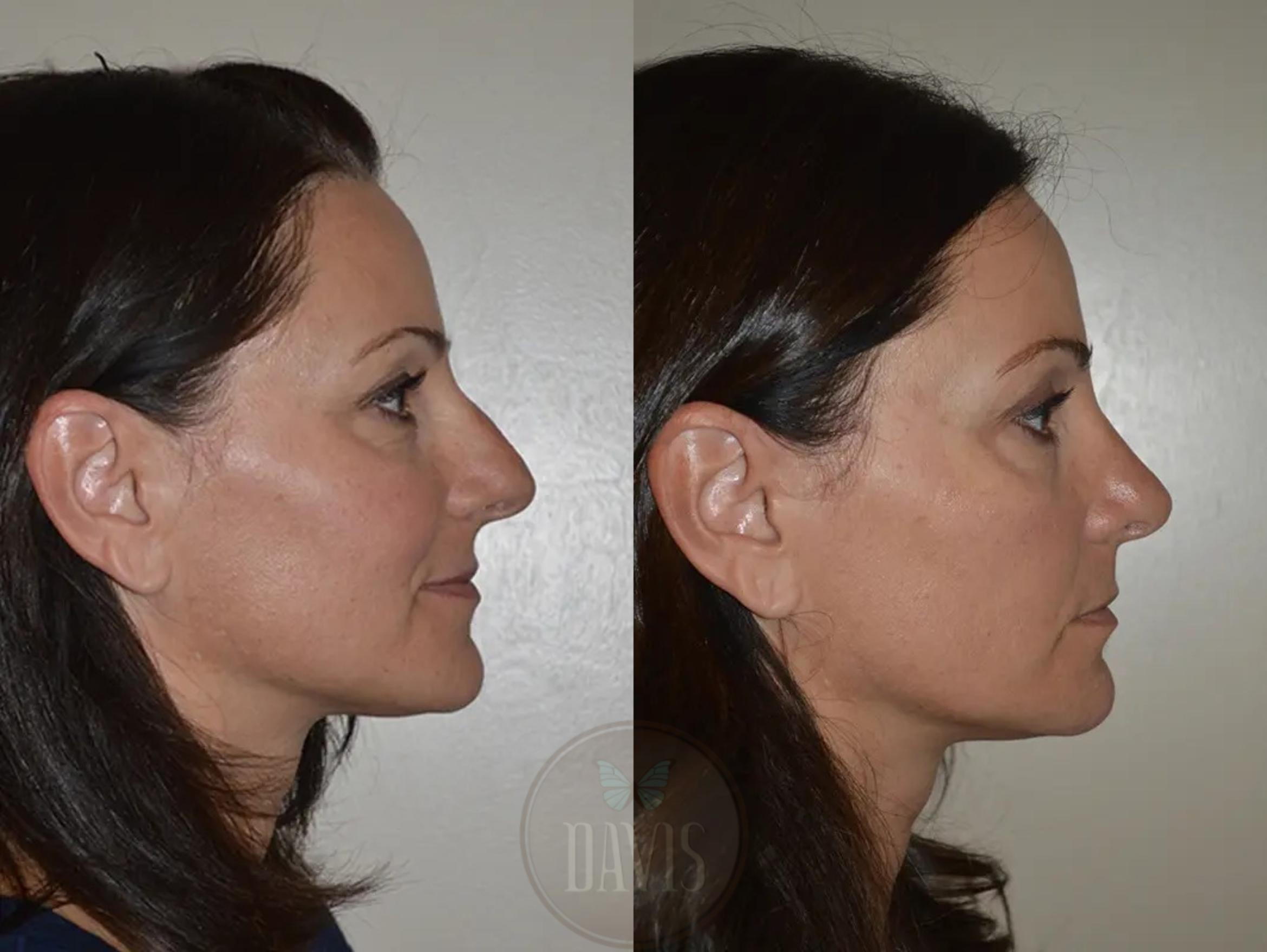 Before & After Female Rhinoplasty Case 1068 View 1 View in Tampa, FL