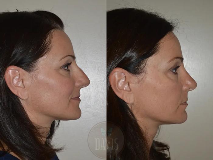 Before & After Female Rhinoplasty Case 1068 View 1 View in Tampa, FL