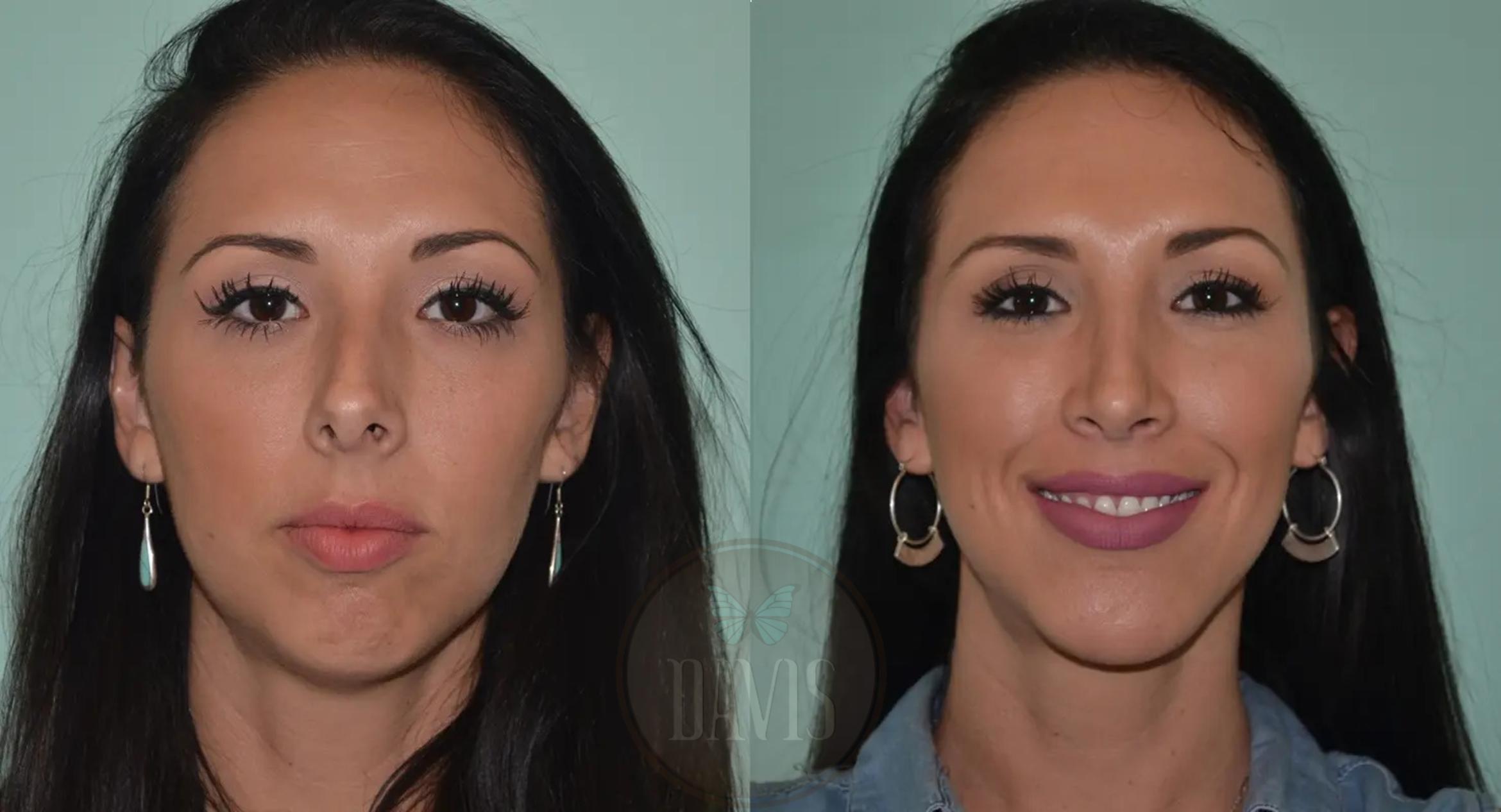 Before & After Female Rhinoplasty Case 1069 View 1 View in Tampa, FL