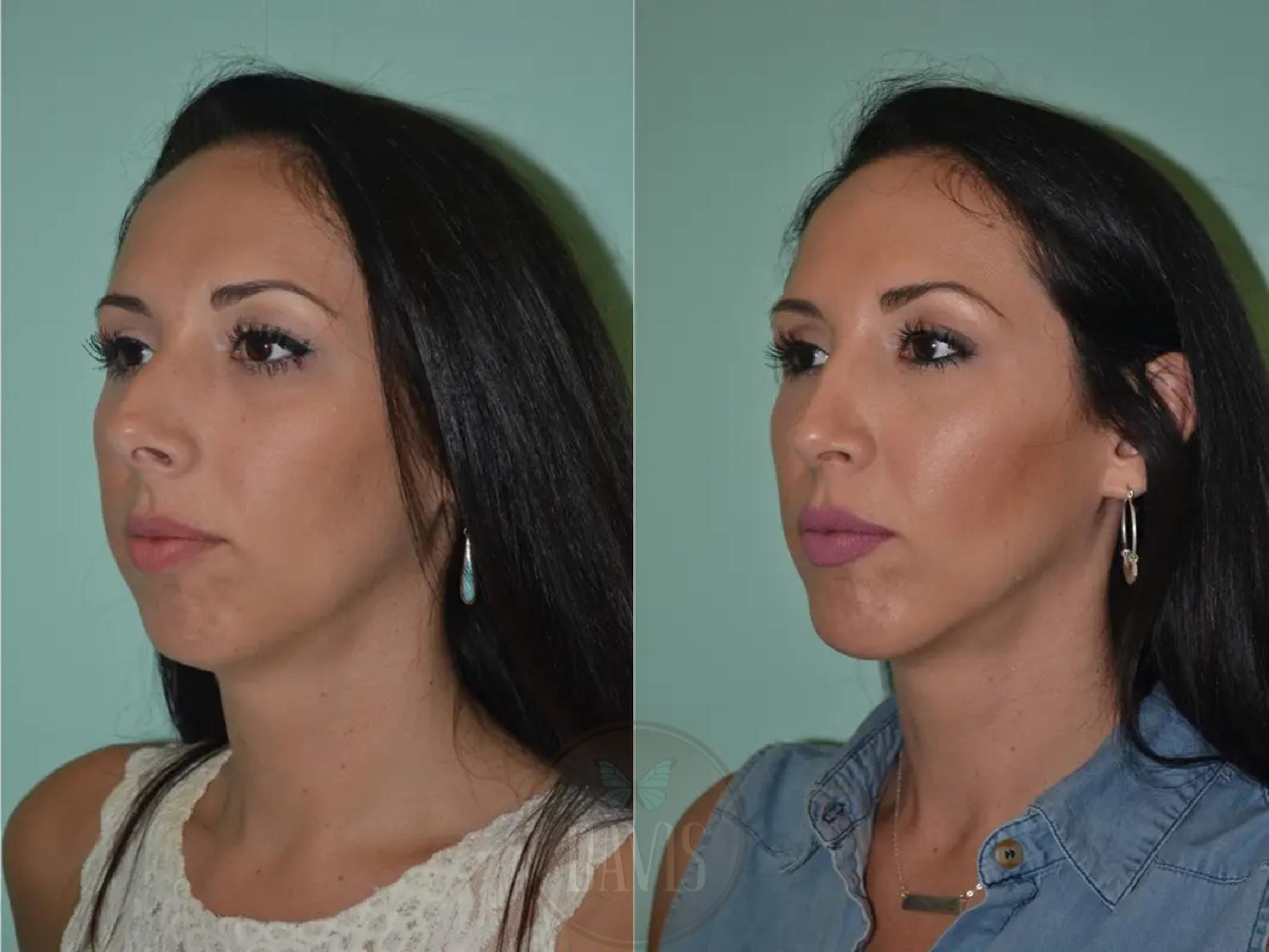 Before & After Female Rhinoplasty Case 1069 View 2 View in Tampa, FL