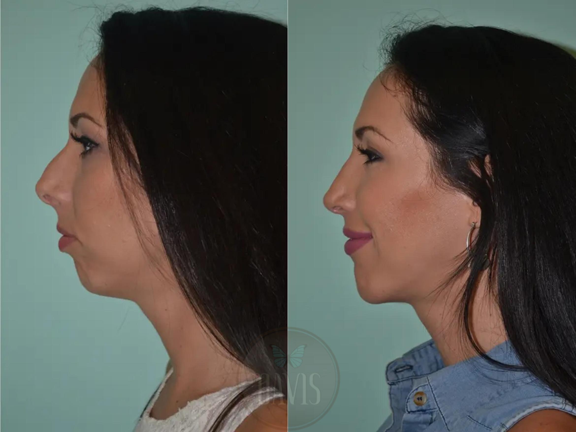 Before & After Female Rhinoplasty Case 1069 View 3 View in Tampa, FL