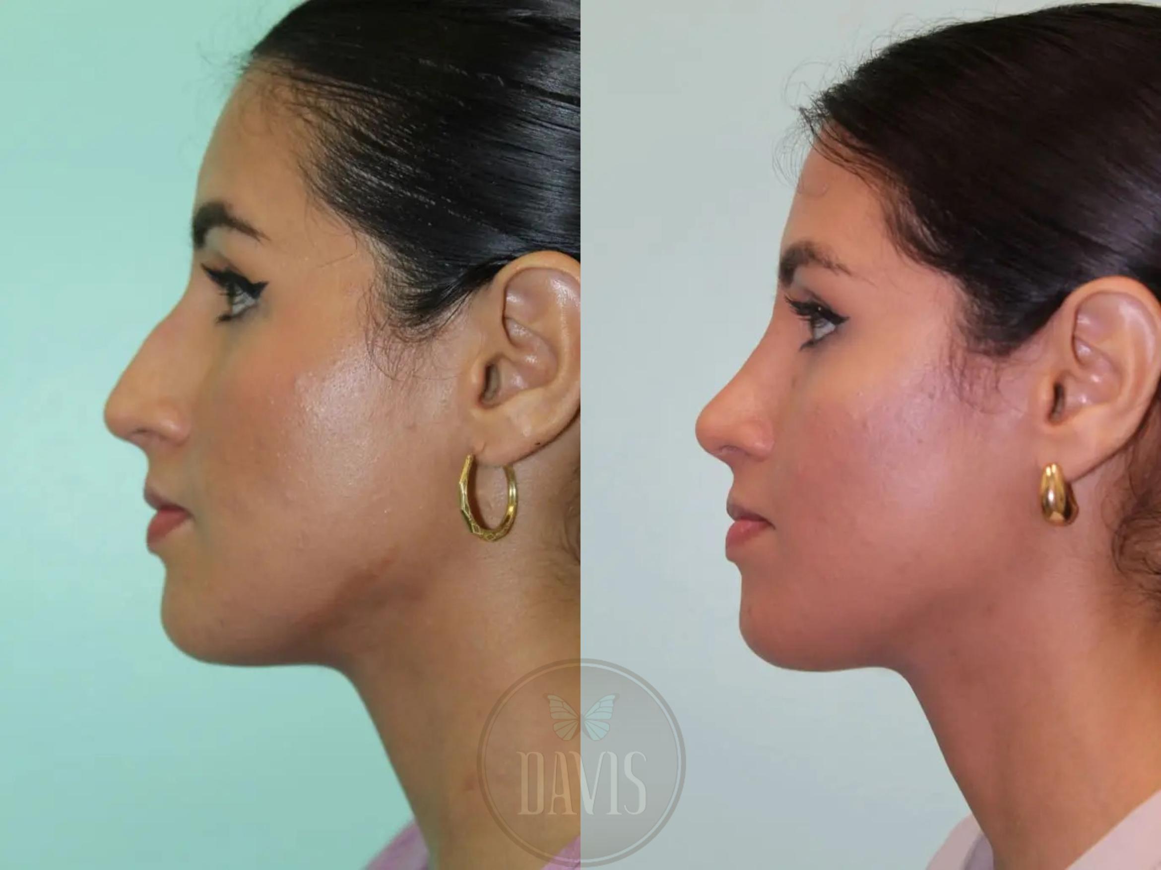 Before & After Female Rhinoplasty Case 1070 View 1 View in Tampa, FL