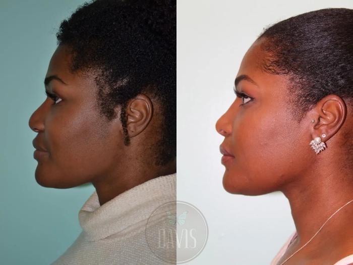 Before & After Female Rhinoplasty Case 1071 View 1 View in Tampa, FL