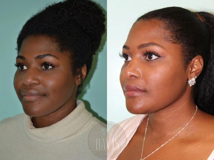 Before & After Female Rhinoplasty Case 1071 View 2 View in Tampa, FL
