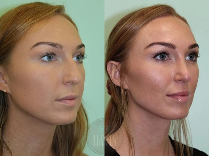 Female Rhinoplasty Before and After Pictures Case 1072 | Tampa, FL ...
