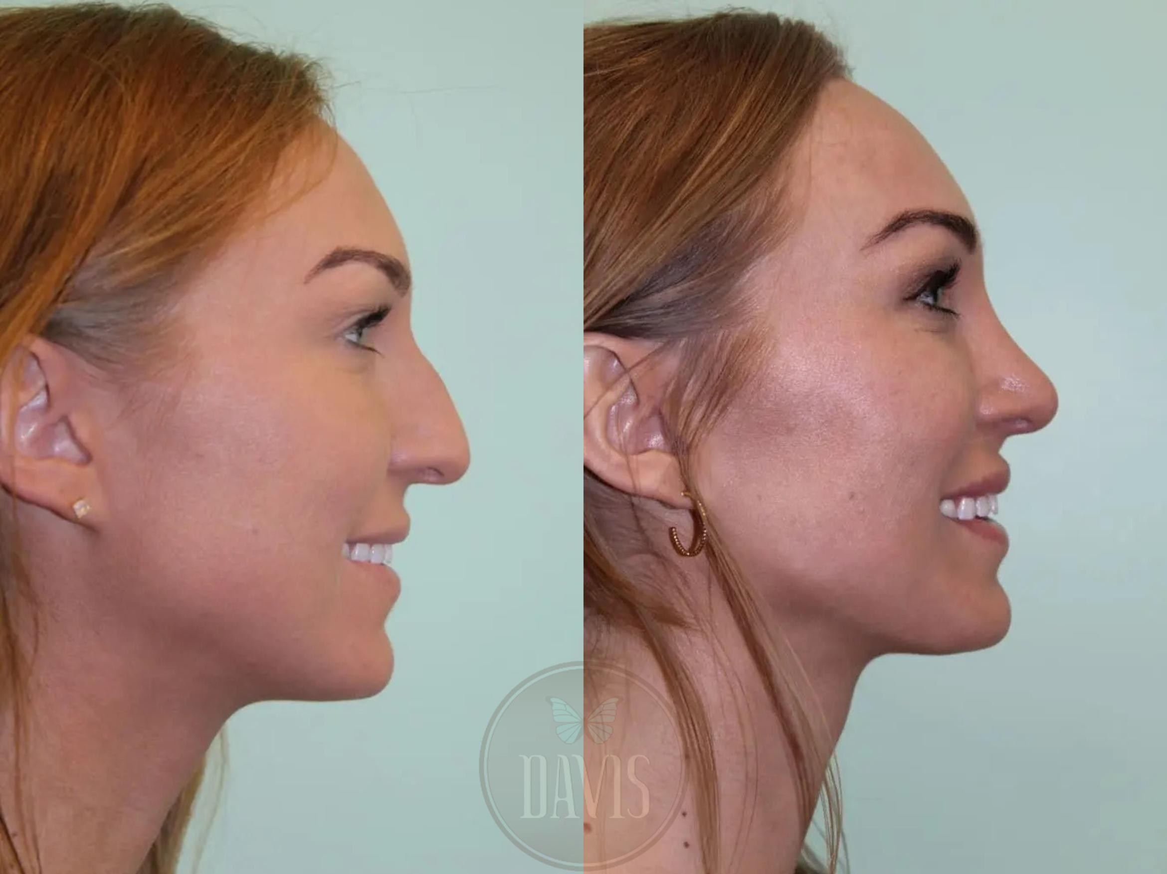 Before & After Female Rhinoplasty Case 1072 View 2 View in Tampa, FL