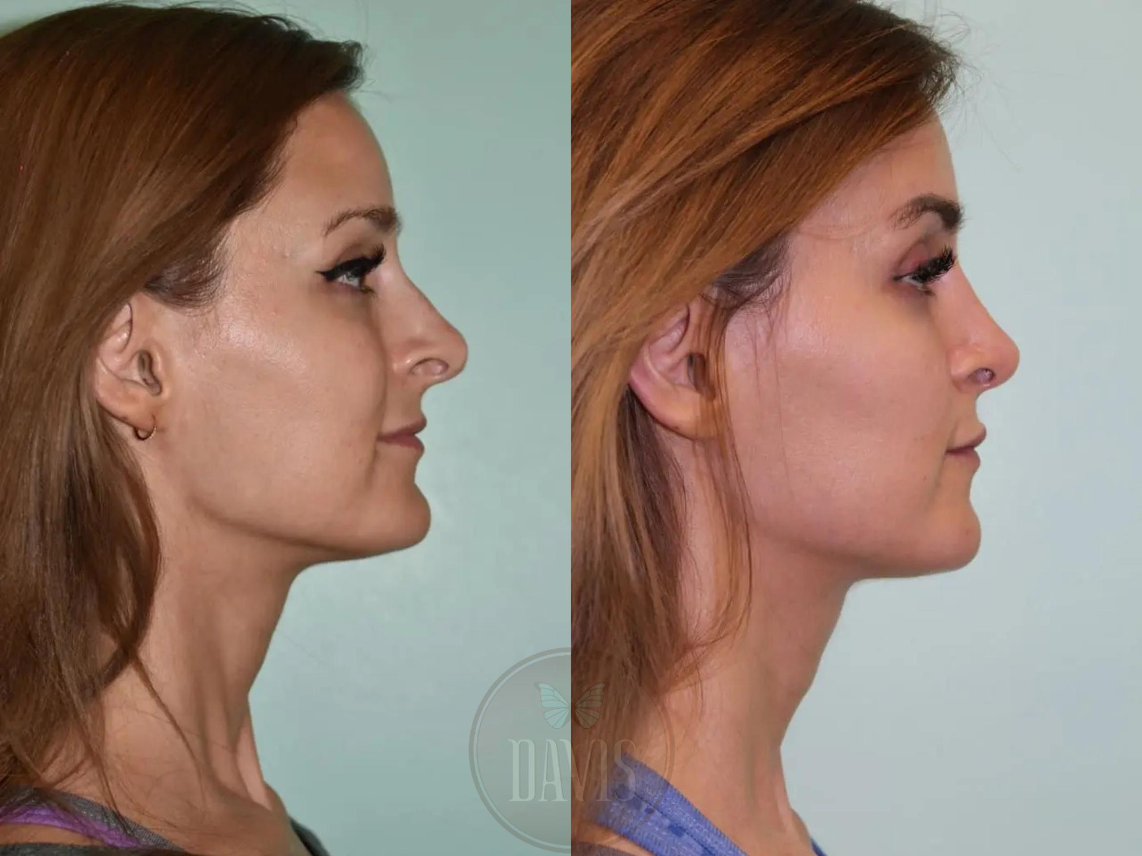 Before & After Female Rhinoplasty Case 1073 View 1 View in Tampa, FL