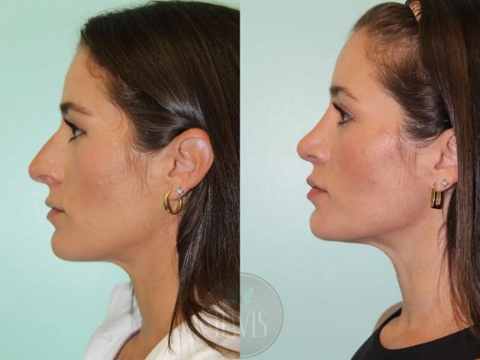 Before & After Female Rhinoplasty Case 1074 View 1 View in Tampa, FL