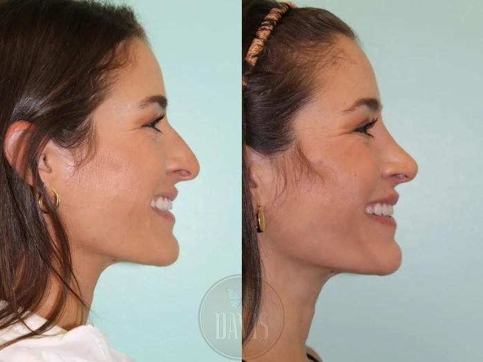 Before & After Female Rhinoplasty Case 1074 View 2 View in Tampa, FL