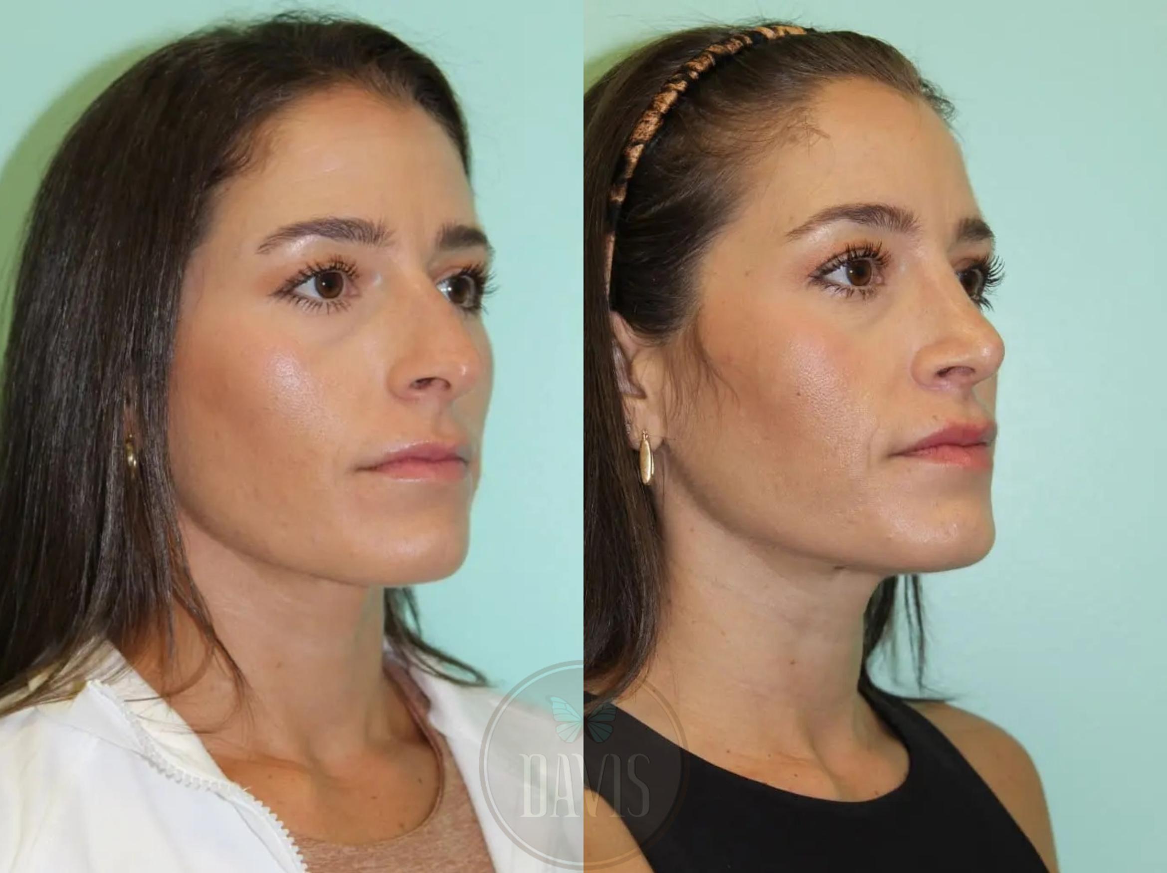 Before & After Female Rhinoplasty Case 1074 View 3 View in Tampa, FL