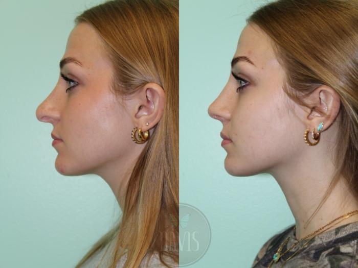 Before & After Female Rhinoplasty Case 1075 Left Side View in Tampa, FL