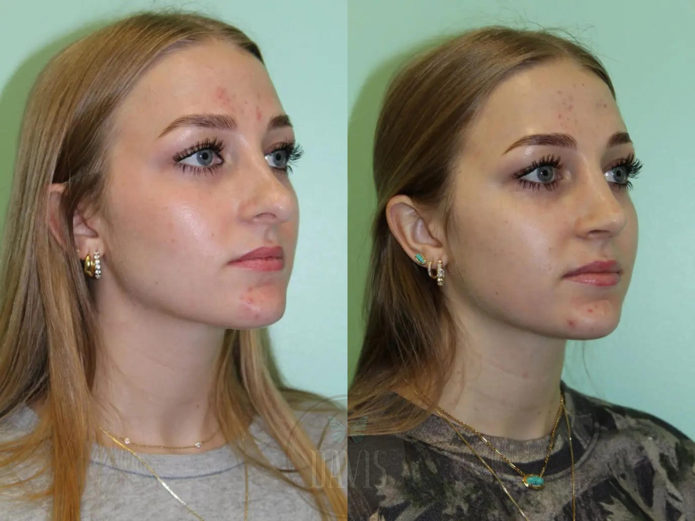Before & After Female Rhinoplasty Case 1075 View 1 View in Tampa, FL
