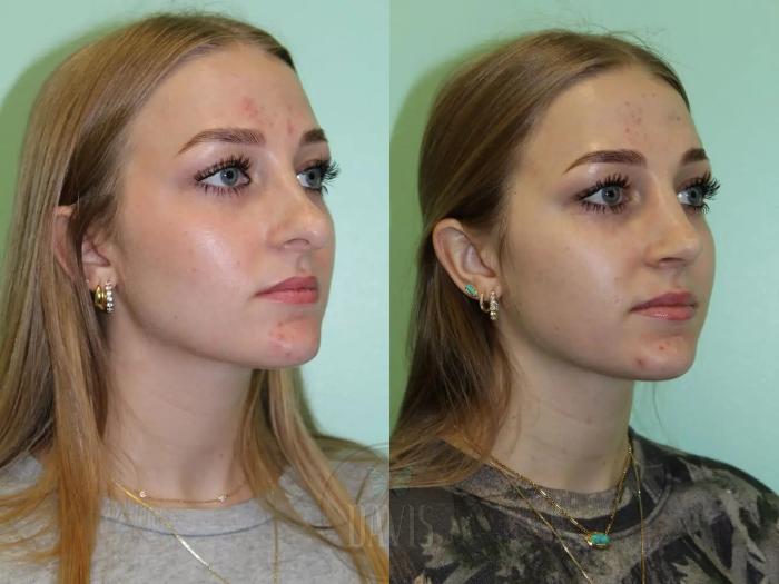 Before & After Female Rhinoplasty Case 1075 View 1 View in Tampa, FL
