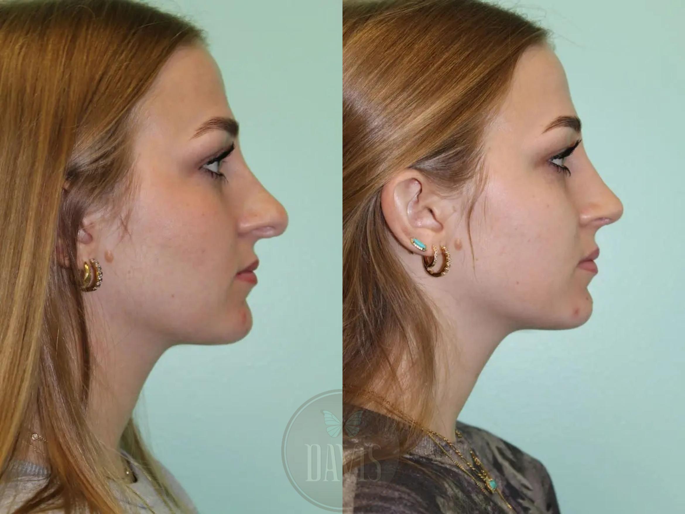 Before & After Female Rhinoplasty Case 1075 View 2 View in Tampa, FL