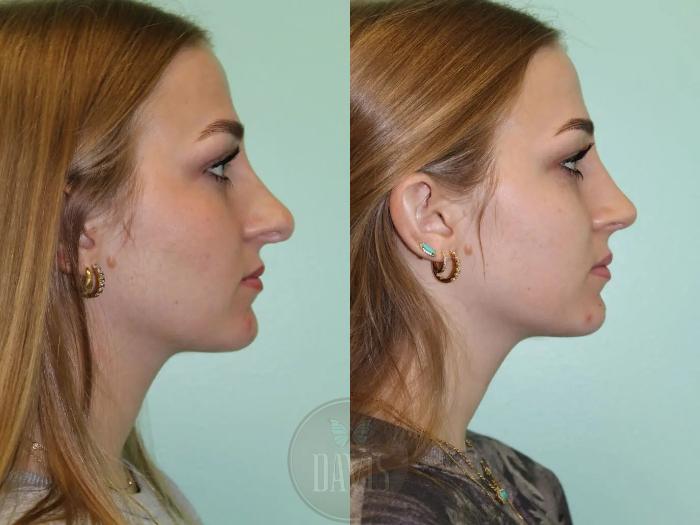Before & After Female Rhinoplasty Case 1075 View 2 View in Tampa, FL
