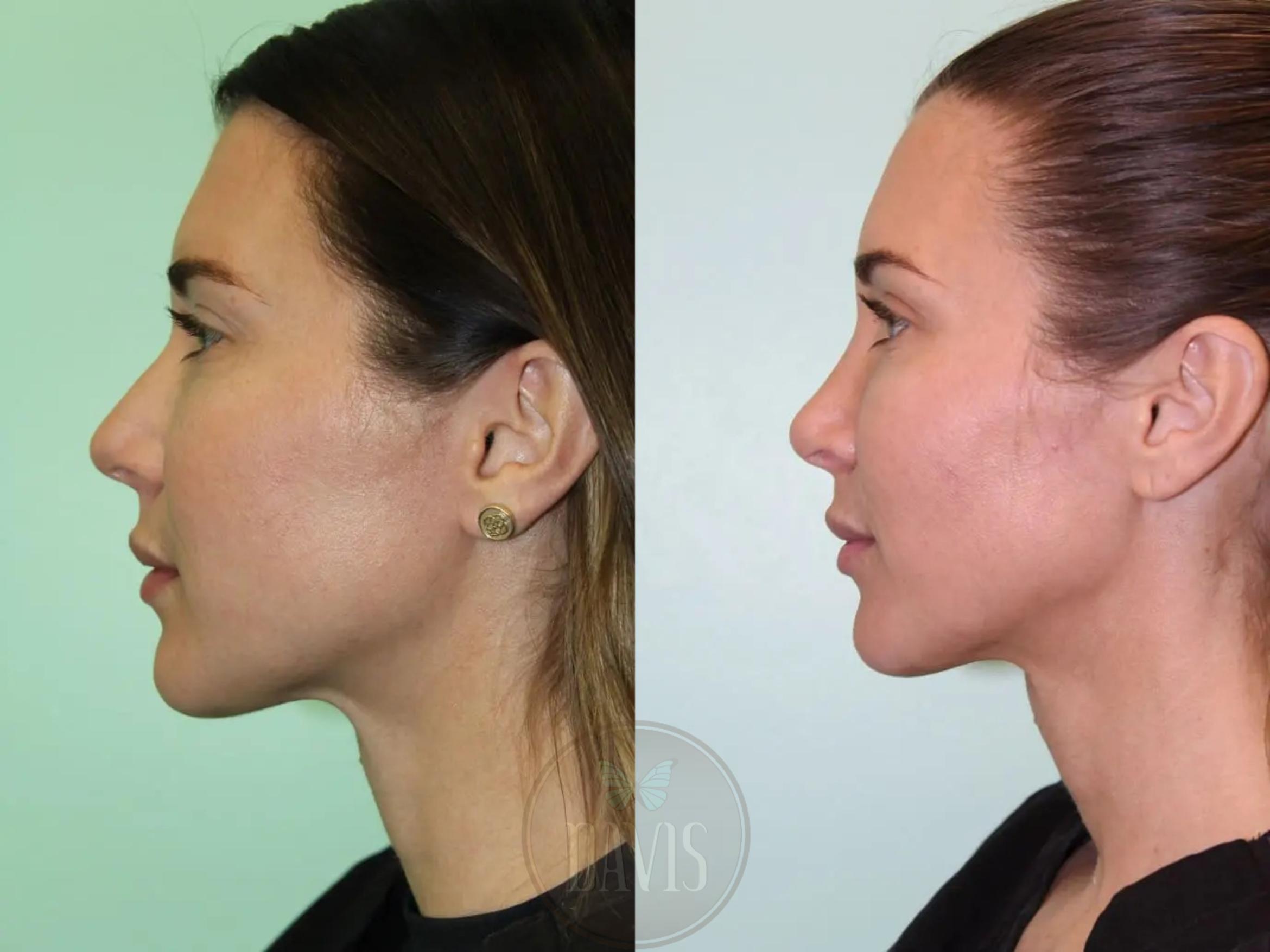 Before & After Female Rhinoplasty Case 1076 View 1 View in Tampa, FL