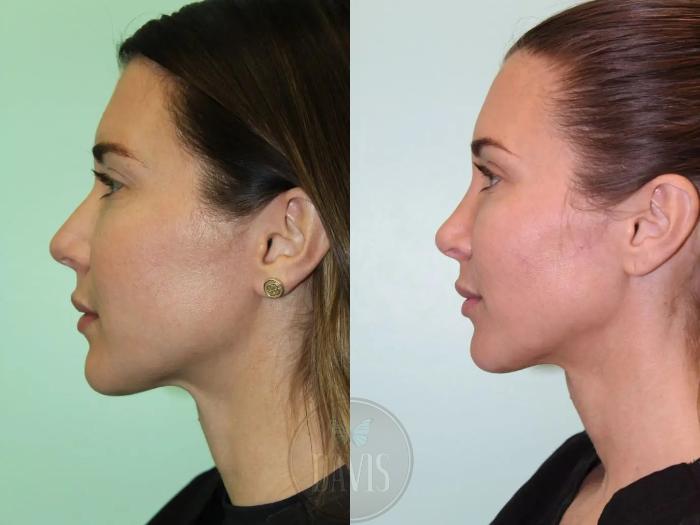 Before & After Female Rhinoplasty Case 1076 View 1 View in Tampa, FL