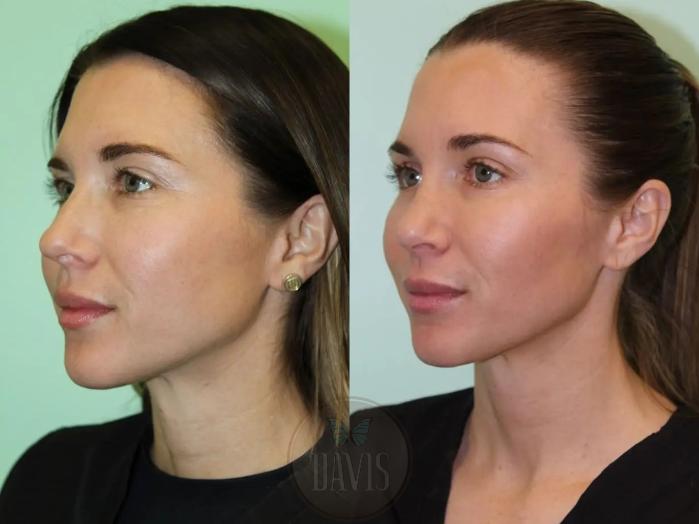 Before & After Female Rhinoplasty Case 1076 View 2 View in Tampa, FL