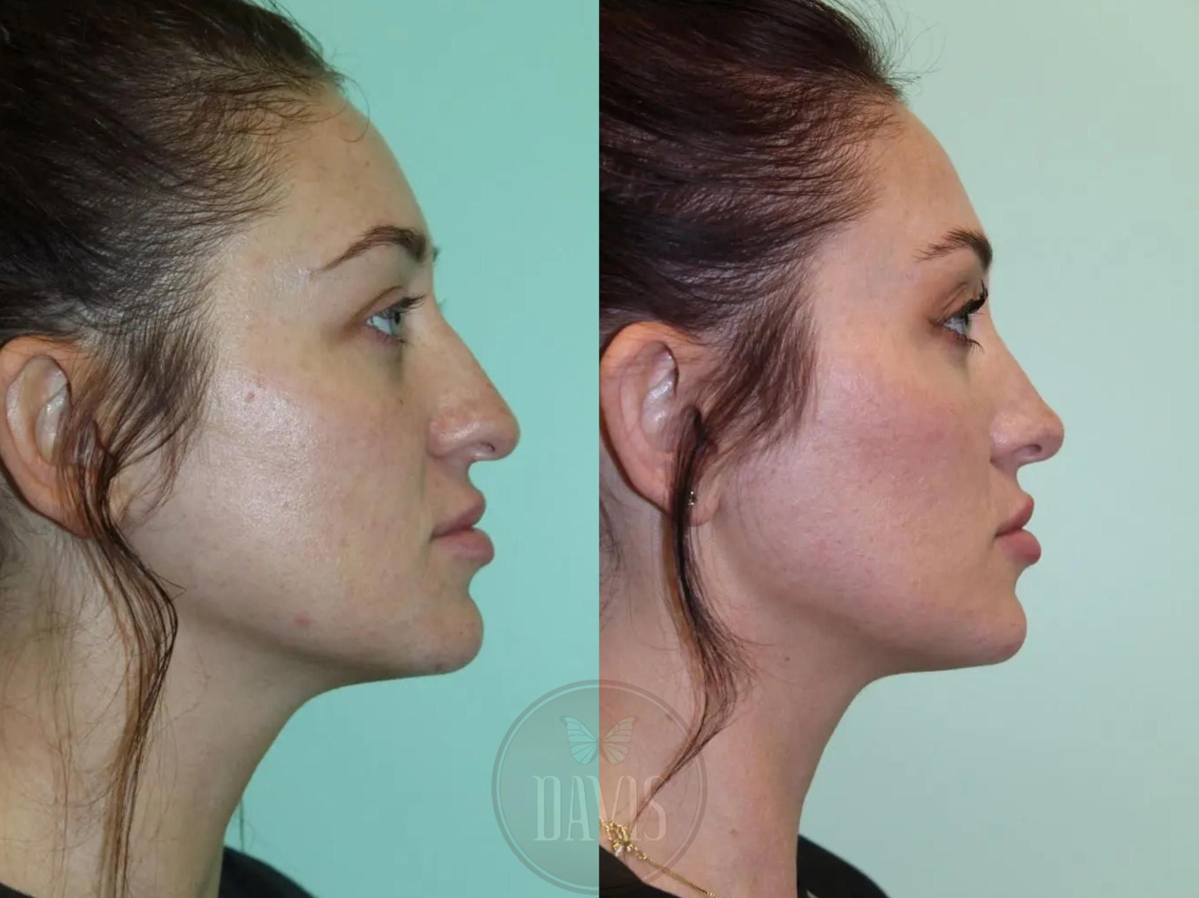 Before & After Female Rhinoplasty Case 1077 View 1 View in Tampa, FL