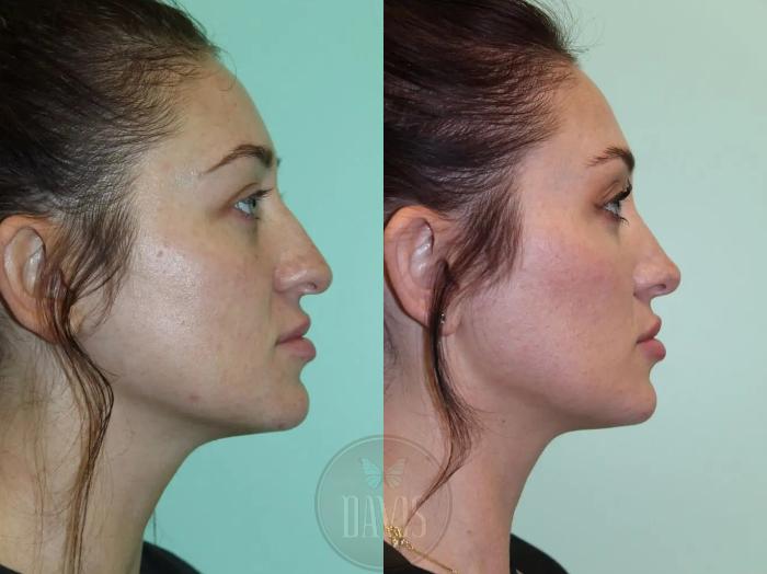 Before & After Female Rhinoplasty Case 1077 View 1 View in Tampa, FL