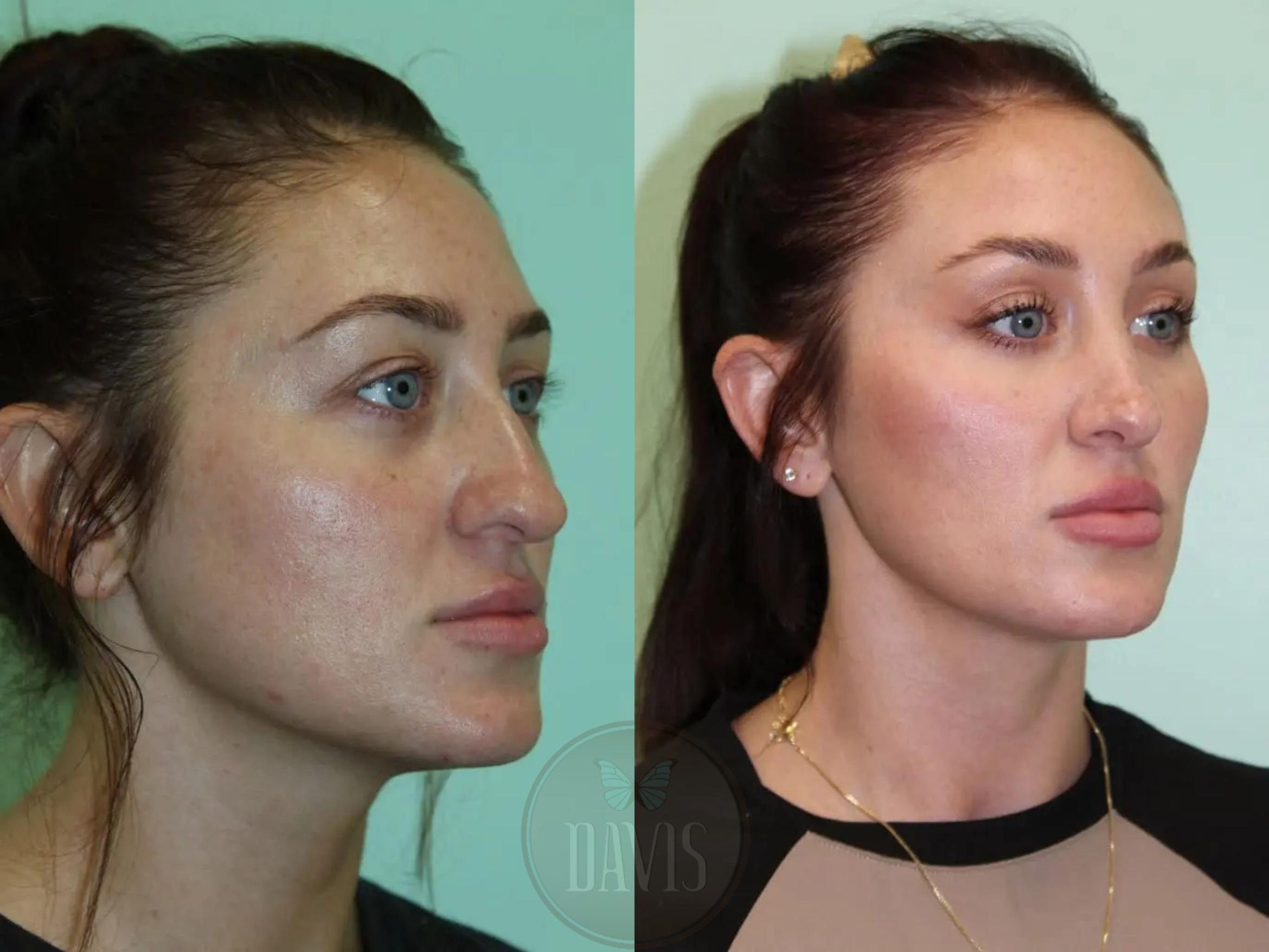 Before & After Female Rhinoplasty Case 1077 View 2 View in Tampa, FL