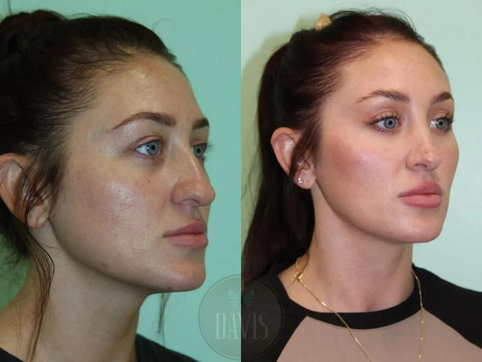 Before & After Female Rhinoplasty Case 1077 View 2 View in Tampa, FL