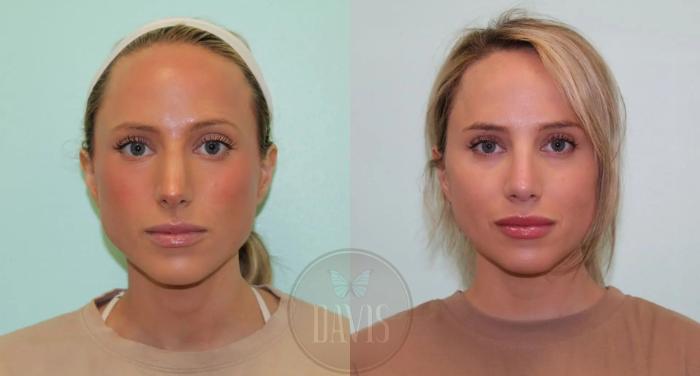 Before & After Female Rhinoplasty Case 1078 View 1 View in Tampa, FL