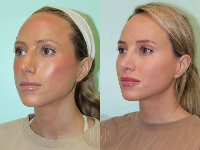 Before & After Female Rhinoplasty Case 1078 View 2 View in Tampa, FL
