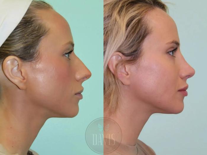 Before & After Female Rhinoplasty Case 1078 View 3 View in Tampa, FL