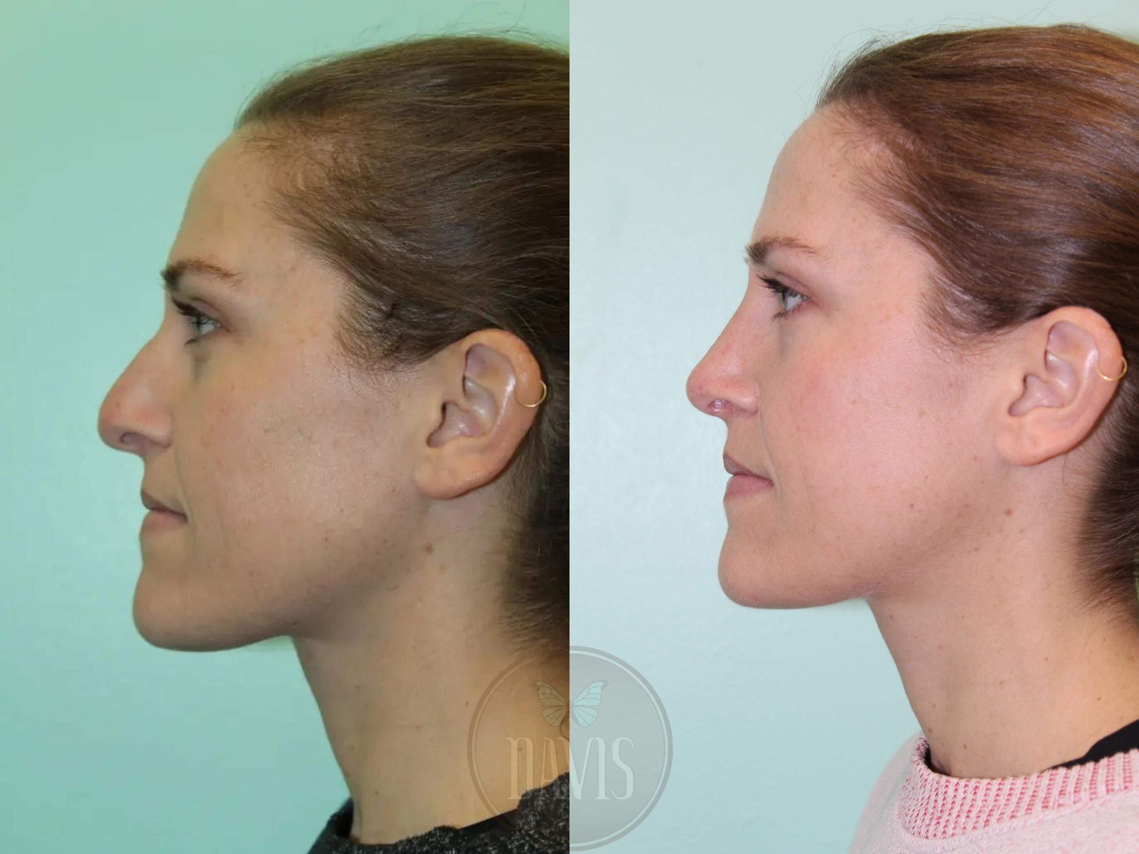 Before & After Female Rhinoplasty Case 1079 View 1 View in Tampa, FL